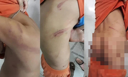Cháu bé lớp 1 bị cha ruột bạo hành vì học hành không tiến bộ