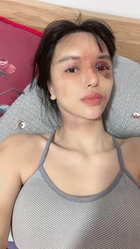 Siêu mẫu Khả Trang tố bị bạo hành, thân thể bầm dập, phải nhập viện  - Ảnh 2.