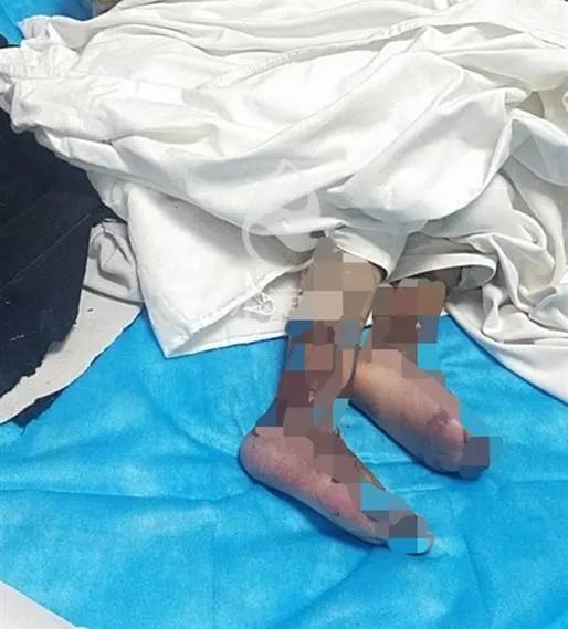 Bị mẹ kế bạo hành 20 ngày, cô bé 4 tuổi cấp cứu vì suy đa tạng, nguy cơ bị cắt cụt 2 chân - Ảnh 5.