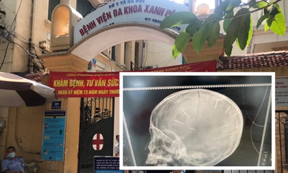 Hé lộ 4 chi tiết kinh hãi vụ bé 3 tuổi nghi bị găm 9 đinh vào đầu, MXH bàng hoàng