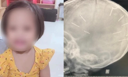 Vụ bé 3 tuổi có 9 dị vật giống đinh găm vào đầu: Cảnh sát hình sự Hà Nội vào cuộc điều tra