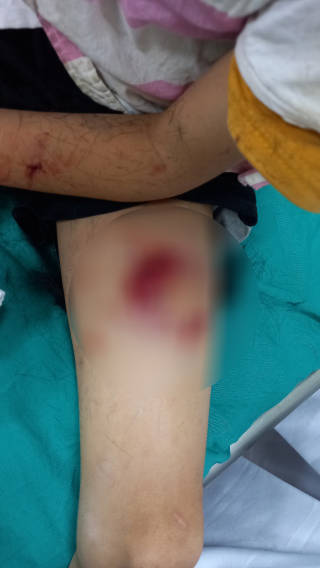 Bé trai 10 tuổi hoảng loạn vì bị chó cắn, vết thương chằng chịt vùng đầu, tay, chân - Ảnh 2.