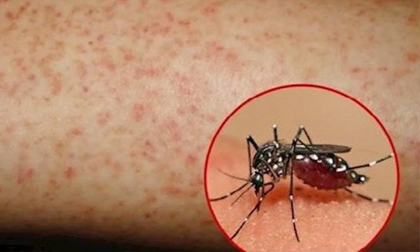 Trẻ sốt xuất huyết: Lưu ý từ ngày 3 đến ngày 7 của bệnh nếu không muốn con gặp nguy hiểm