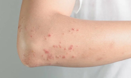4 dấu hiệu cảnh báo gan bạn đang không được khỏe chớ chủ quan