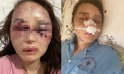 Cán bộ QLTT đánh bạn gái dã man vì ghen tuông đối diện tội danh nào?