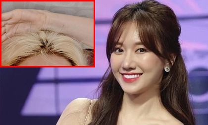 Hari Won tiếp tục gây lo lắng khi hé lộ hình ảnh đầu đầy kim châm cứu sau chứng bệnh liệt nửa mặt