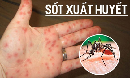 Dịch sốt xuất huyết ở Hà Nội diễn biến phức tạp, chuyên gia đưa ra khuyến cáo