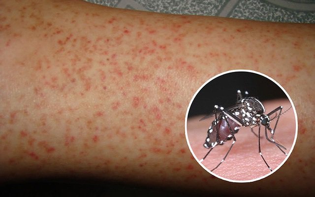 Cách chăm sóc và dùng thuốc khi mắc sốt xuất huyết tại nhà - Ảnh 1.