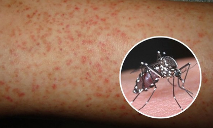 Cách chăm sóc và dùng thuốc khi mắc sốt xuất huyết tại nhà