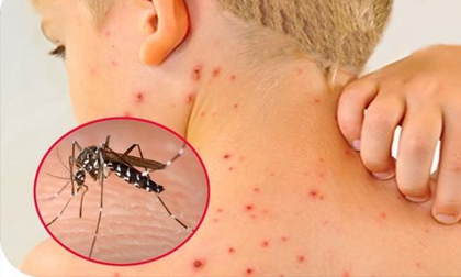 Số mắc sốt xuất huyết đã vượt 300.000 ca, lưu ý quan trọng để tránh bệnh diễn biến nặng
