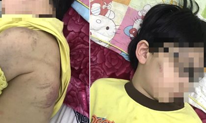 Nghi vấn, cháu bé 8 tuổi bị mẹ đánh nhập viện do chưa làm bài tập