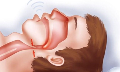 Bác sĩ tim mạch: Tiếng ngáy khi ngủ phản ánh tình trạng sức khỏe không thể bỏ qua