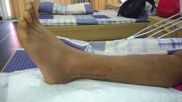 Đôi chân mang 6 chiếc đinh và màn 