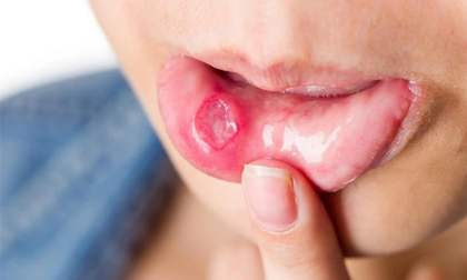 Vết loét trong miệng tưởng chừng bệnh thông thường nhưng lại có thể là dấu hiệu ung thư