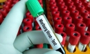Bộ Y tế đề nghị giám sát chặt nguy cơ lây nhiễm virus Marburg vào Việt Nam