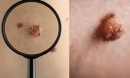 Có nốt ruồi trên cơ thể có nghĩa là bạn bị ung thư? Nốt ruồi ác tính có 5 đặc điểm bạn nên chú ý