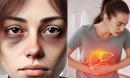 Dấu hiệu cảnh báo gan nhiễm mỡ 'hiện hình' ngay trên mặt, nhiều người vẫn làm ngơ
