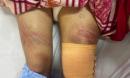 Xác minh vụ nữ sinh lớp 7 bị bố đánh phải nhập viện