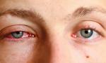 4 thay đổi bất thường ở đôi mắt chứng tỏ bạn đang bị ung thư, tiếc không ai để ý 4 thay đổi bất thường ở đôi mắt chứng tỏ bạn đang bị ung thư, tiếc không ai để ý