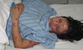 canh-bao-can-benh-nguy-hiem-viem-nao-mo-cau-tai-ha-noi-245486.html