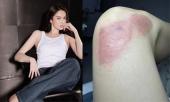 ngoc-trinh-tiet-lo-hinh-anh-vet-thuong-sau-hon-mot-thang-dieu-tri-mung-ro-vi-da-gan-binh-phuc-400627.html