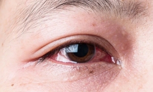 Bác sĩ chuyên khoa chia sẻ lý do bệnh đau mắt đỏ phức tạp hơn mọi năm và lưu ý quan trọng khi điều trị bệnh