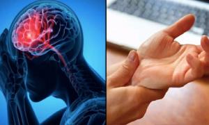 Dấu hiệu cảnh báo đột quỵ trước một tuần tuyệt đối đừng bỏ qua