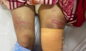 Xác minh vụ nữ sinh lớp 7 bị bố đánh phải nhập viện