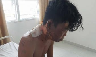 Chị gái đổ nồi nước sôi lên người em trai Chị gái đổ nồi nước sôi lên người em trai