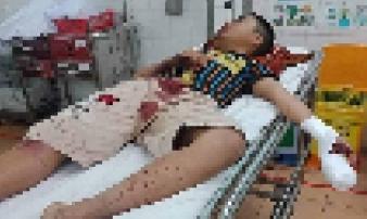 Pháo tự chế phát nổ trên tay thiếu niên 14 tuổi Pháo tự chế phát nổ trên tay thiếu niên 14 tuổi