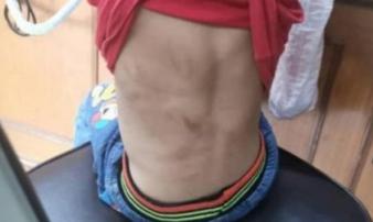 Mẹ bỏ con gái 2 tuổi mình đầy vết sẹo và bầm tím trước cửa trung tâm phúc lợi vì lý do xót xa Mẹ bỏ con gái 2 tuổi mình đầy vết sẹo và bầm tím trước cửa trung tâm phúc lợi vì lý do xót xa