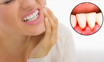 Chảy máu chân răng là lời cảnh báo bạn đang đối diện với căn bệnh nguy hiểm, chớ coi thường Chảy máu chân răng là lời cảnh báo bạn đang đối diện với căn bệnh nguy hiểm, chớ coi thường