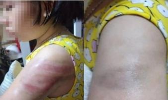 Bé gái lớp 4 bị cô giáo đánh bầm tím cánh tay do viết bài chậm Bé gái lớp 4 bị cô giáo đánh bầm tím cánh tay do viết bài chậm