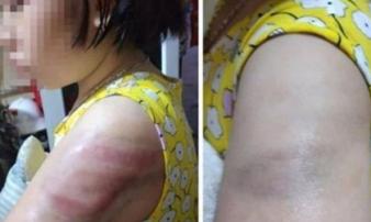 Vụ đánh học sinh lớp 4 bầm tím tay vì viết chậm: Cô giáo trẻ nói gì? Vụ đánh học sinh lớp 4 bầm tím tay vì viết chậm: Cô giáo trẻ nói gì?