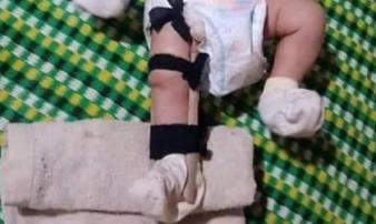 Vụ cha đánh gãy chân con 2 tháng tuổi: Bịa đặt để kêu gọi cộng đồng mạng hỗ trợ Vụ cha đánh gãy chân con 2 tháng tuổi: Bịa đặt để kêu gọi cộng đồng mạng hỗ trợ