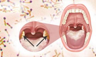 Liên tiếp xuất hiện ổ bệnh bạch hầu: Nguy hiểm thế nào và cách phòng ngừa? Liên tiếp xuất hiện ổ bệnh bạch hầu: Nguy hiểm thế nào và cách phòng ngừa?