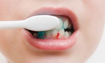 Chảy máu chân răng: Dấu hiệu cảnh báo nhiều bệnh nguy hiểm Chảy máu chân răng: Dấu hiệu cảnh báo nhiều bệnh nguy hiểm