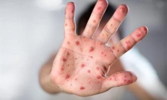 Tay chân miệng lại 'tái xuất', độ tuổi nào dễ mắc bệnh này nhất? Tay chân miệng lại 'tái xuất', độ tuổi nào dễ mắc bệnh này nhất?