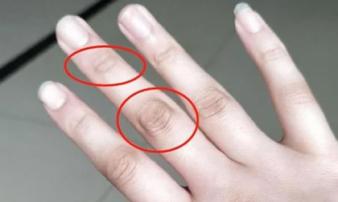 4 dấu hiệu bất thường ở ngón tay giữa cảnh báo gan suy yếu, hi vọng bạn không có cái nào 4 dấu hiệu bất thường ở ngón tay giữa cảnh báo gan suy yếu, hi vọng bạn không có cái nào