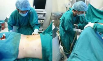 Một phụ nữ 50 tuổi tử vong sau khi hút mỡ bụng 3 ngày Một phụ nữ 50 tuổi tử vong sau khi hút mỡ bụng 3 ngày