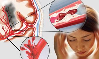 12 tuổi đã bị tai biến mạch máu não, BS cảnh báo 6 việc người trẻ hay làm khiến bệnh tật đến nhanh 12 tuổi đã bị tai biến mạch máu não, BS cảnh báo 6 việc người trẻ hay làm khiến bệnh tật đến nhanh