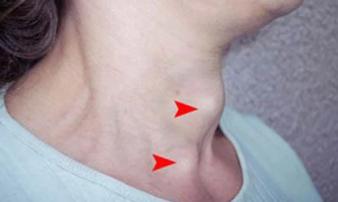 5 hiện tượng lạ ở vùng cổ cảnh báo nguy cơ mắc K tuyến giáp, gặp 1/5 cũng đáng lo ngại, cần đi khám 5 hiện tượng lạ ở vùng cổ cảnh báo nguy cơ mắc K tuyến giáp, gặp 1/5 cũng đáng lo ngại, cần đi khám