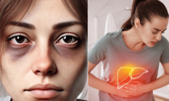 Dấu hiệu cảnh báo gan nhiễm mỡ 'hiện hình' ngay trên mặt, nhiều người vẫn làm ngơ Dấu hiệu cảnh báo gan nhiễm mỡ 'hiện hình' ngay trên mặt, nhiều người vẫn làm ngơ