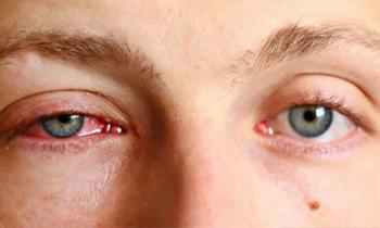 4 thay đổi bất thường ở đôi mắt chứng tỏ bạn đang bị ung thư, tiếc không ai để ý 4 thay đổi bất thường ở đôi mắt chứng tỏ bạn đang bị ung thư, tiếc không ai để ý