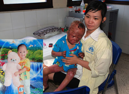 Bé Vũ Quốc Linh trước và sau khi bị bố đẻ tưới xăng 