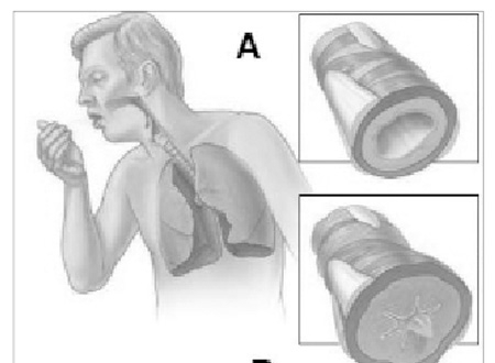 Sự phù mạch trên đường thở (A: bình thường, B: bị phù mạch).  