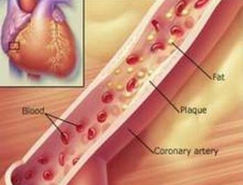 Mảng xơ vữa trong lòng mạch - nguyên nhân dẫn tới tắc mạch