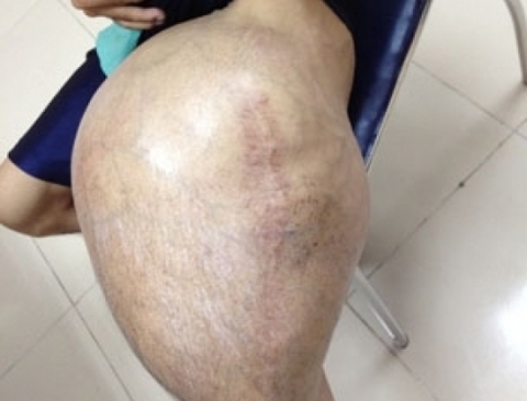 Chân trái bệnh nhân trước khi phẫu thuật - Ảnh: Bệnh viện cung cấp