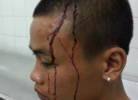 Vết thương trên đầu anh Minh do bị vợ chồng chủ quán cơm gây nên