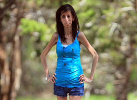 Thân hình gầy gò khiến Lizzie Velasquez luôn mất tự tin.